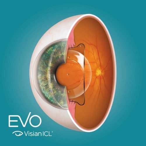 EVO-Visian-ICL-en-ojo-anatomico